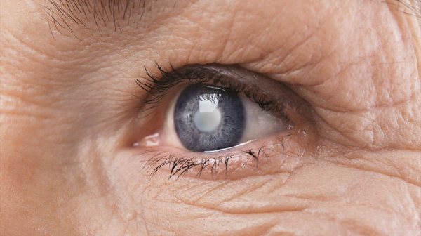  Early symptoms of glaucoma