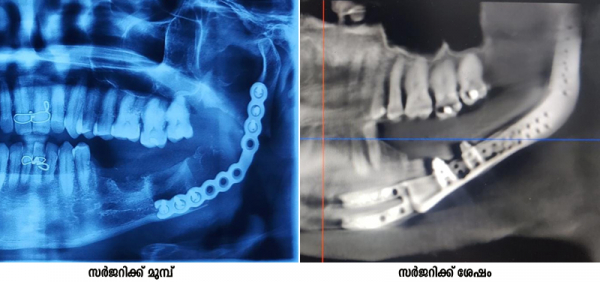 Rare surgical success at Kottayam Medical College  Complex arthroplasty of the mandible
