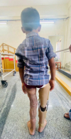 A five-year-old can still walk with a prosthetic leg  Thrissur Medical College as a model